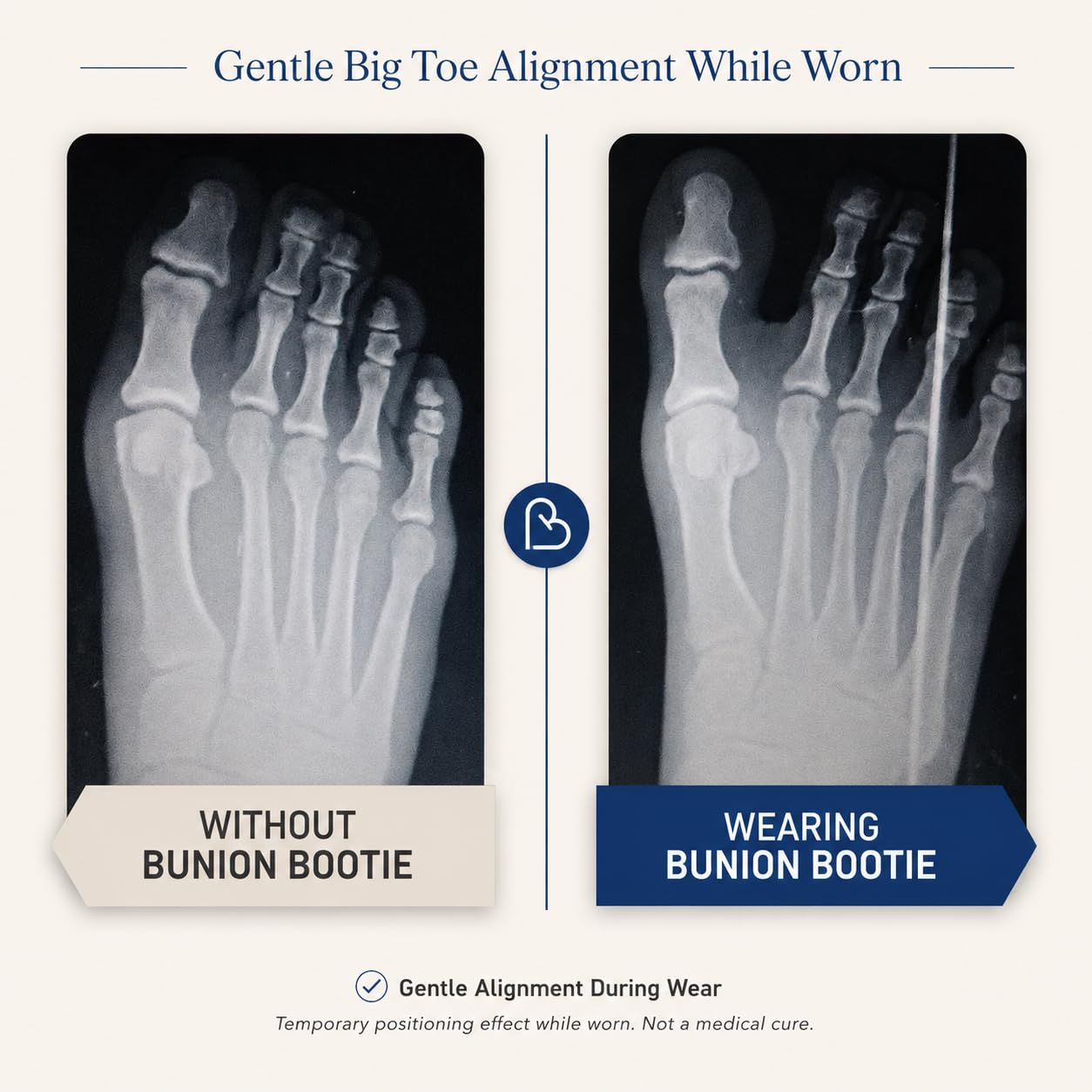 Bunion Corrector for Women and Men, Big Toe Straightener. XSmall-Left | Ultra Thin Bunion Sleeve Sock, Hallux Valgus Relief and Toe Alignment, Fits Inside All Shoes for Day and Night Wear
